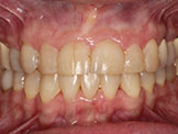 missing lateral incisors after