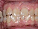 missing lateral incisors before